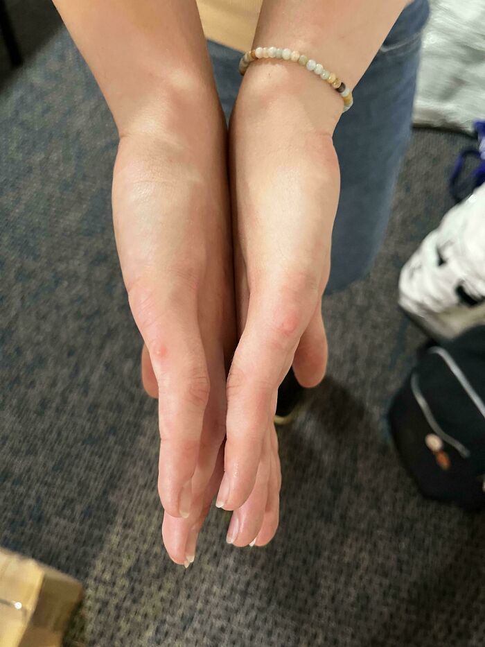 Roommate Was Born with 12 Fingers, Had Some Removed!