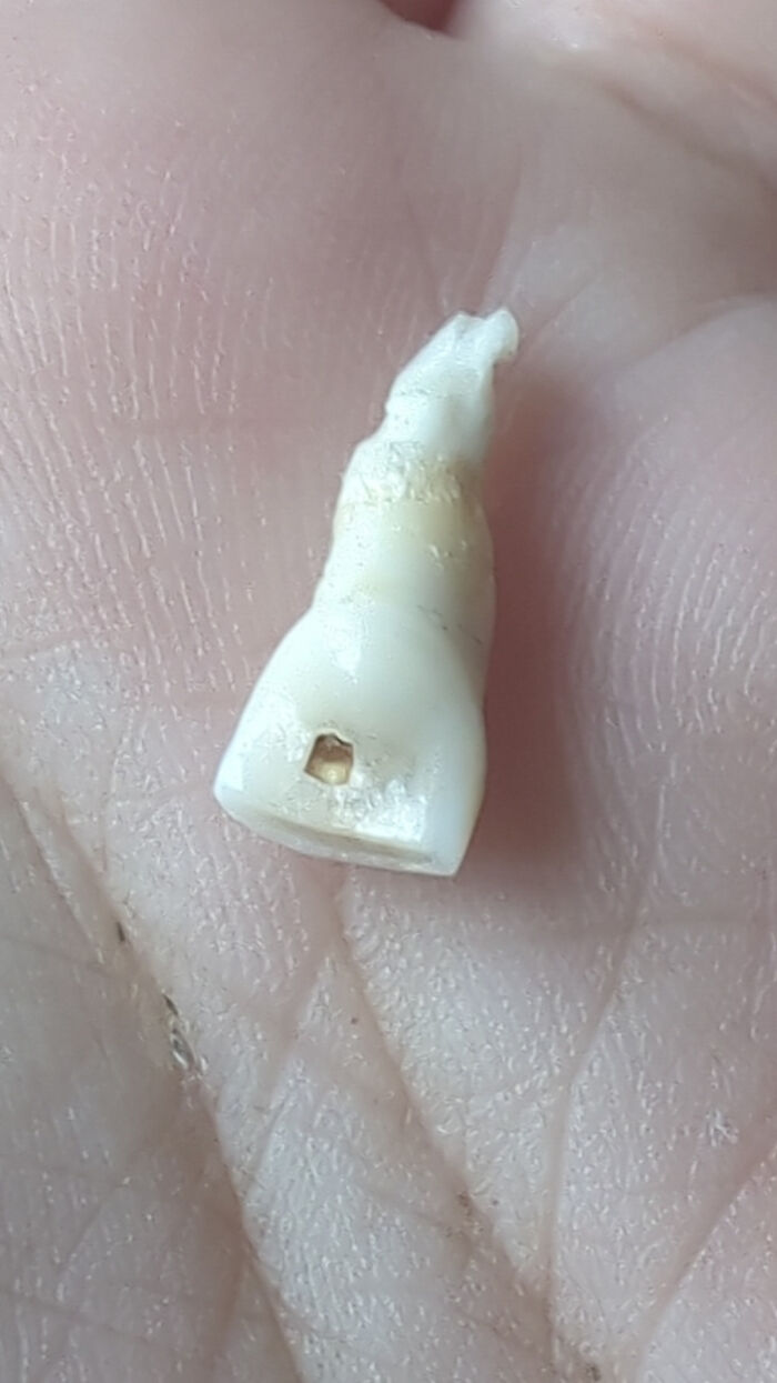 Son’s Tooth Grew a Nerve Out the Back—Who Knew?