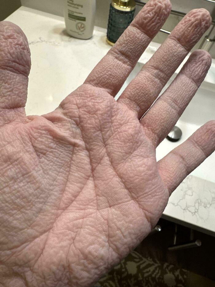 My Palms After a 10-Minute Shower Looking Freaky
