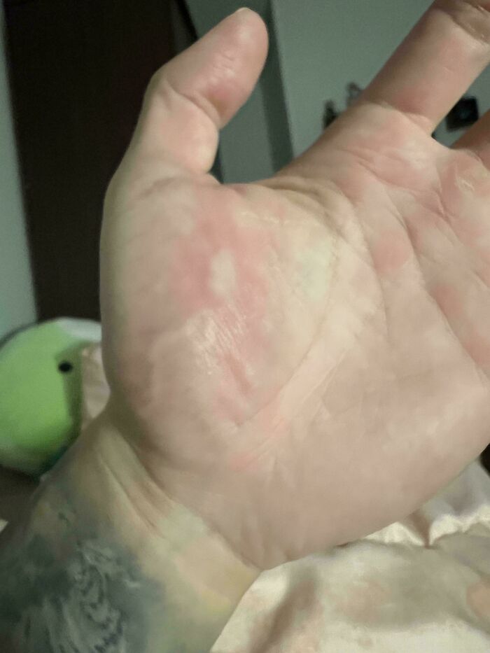 Mosquito Bite Crawling Down My Vein? Yep, Real Life!