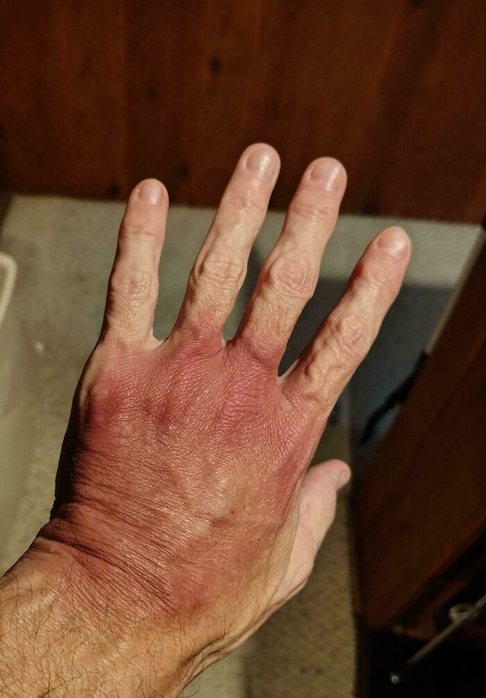 IV Bruise 4 Days After Surgery—Ouch!