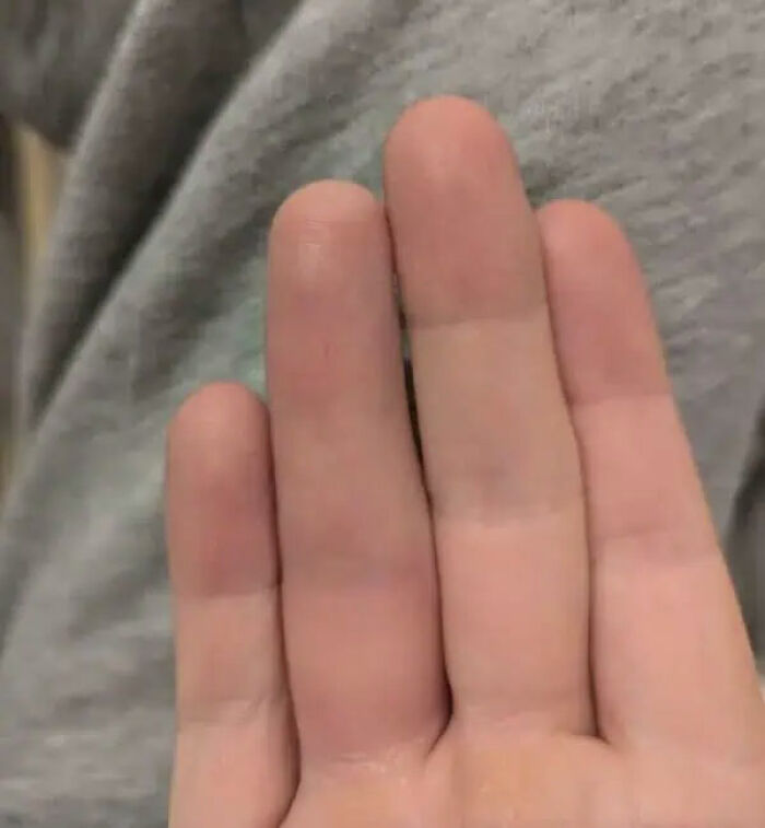 Broke My Ring Finger, Now the Crease Is Disappearing!