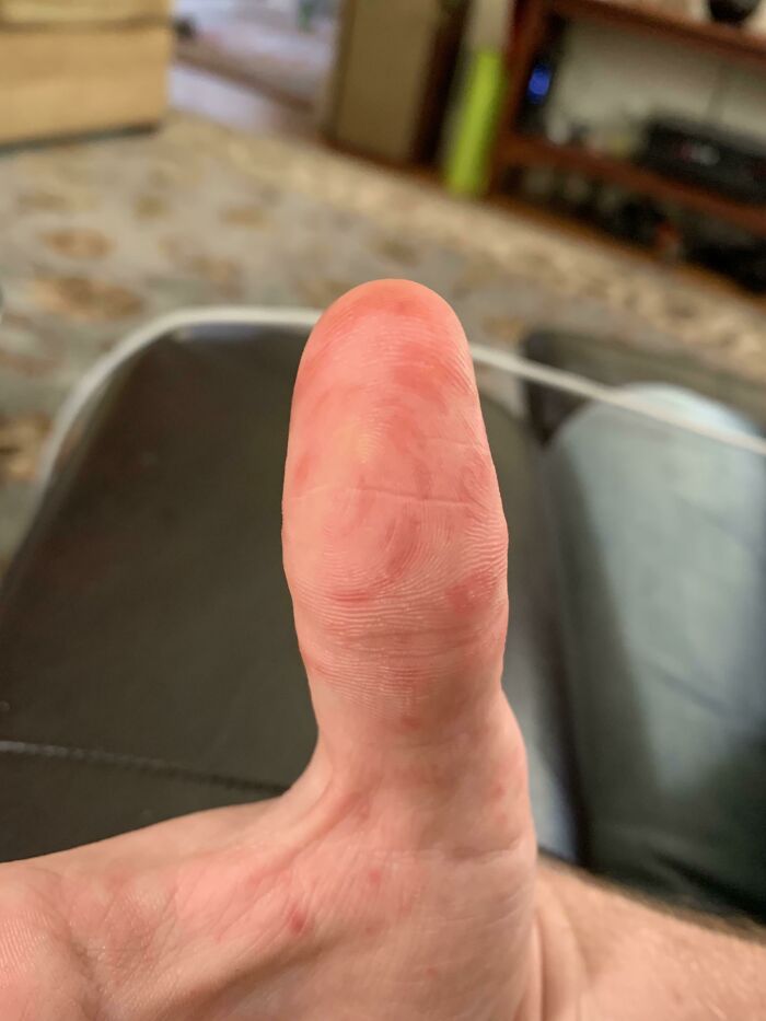 Hand, Foot, and Mouth Disease Left Rashes Following My Fingerprints!