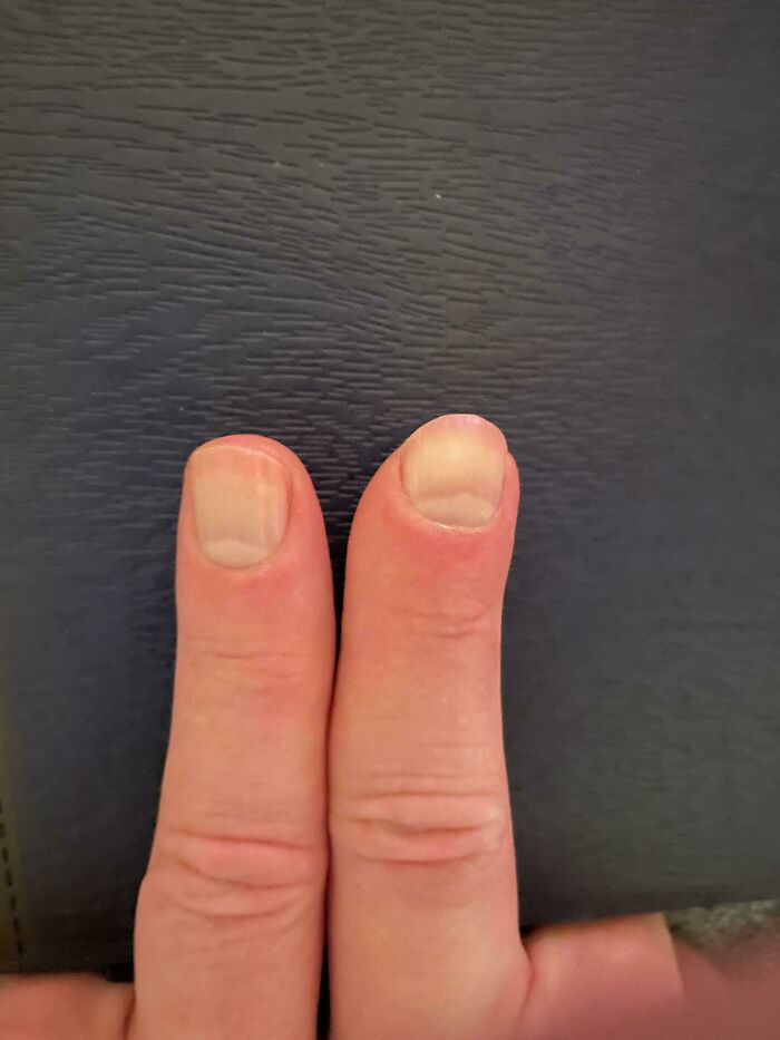 Finger Nearly Cut Off, Graft Saved It!