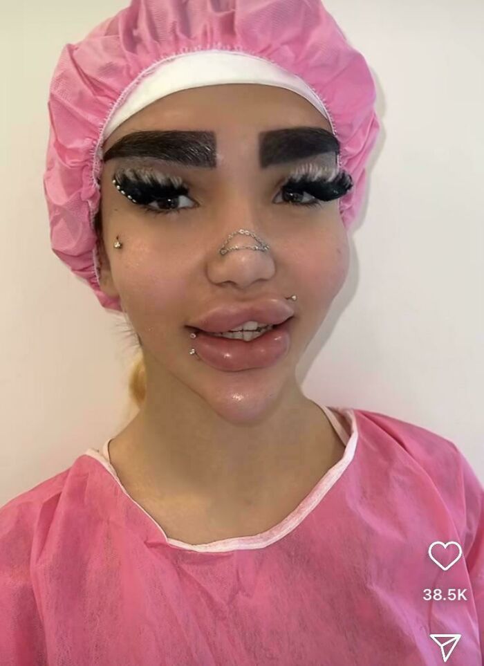 Eyebrow Implants? Yep, Found On Instagram.