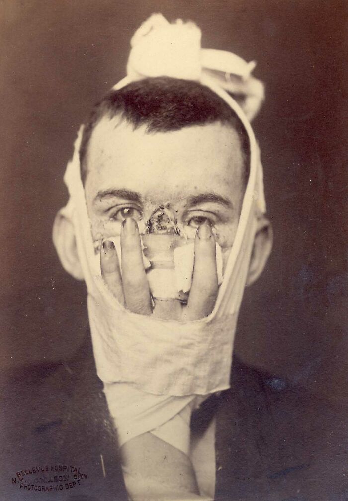 Guy Who Got A Nose From His Own Finger