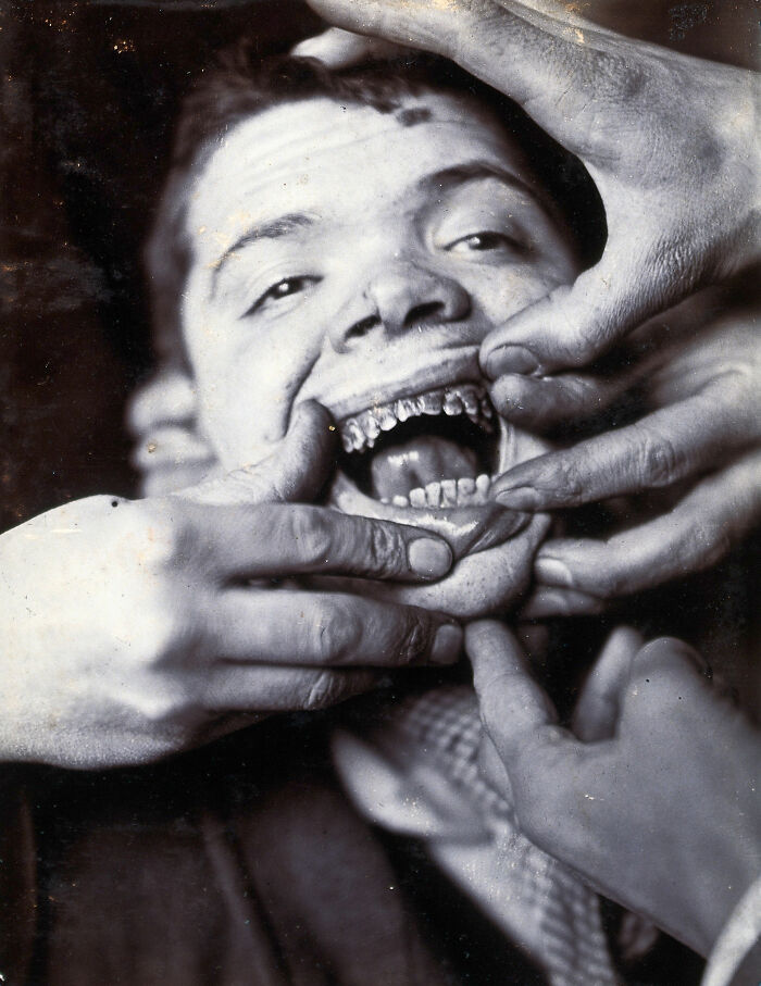 Boy With Rotten Teeth, London, 1890–1910
