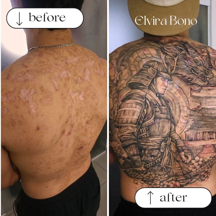 Acne Scars No More! Tattoo Style Activated