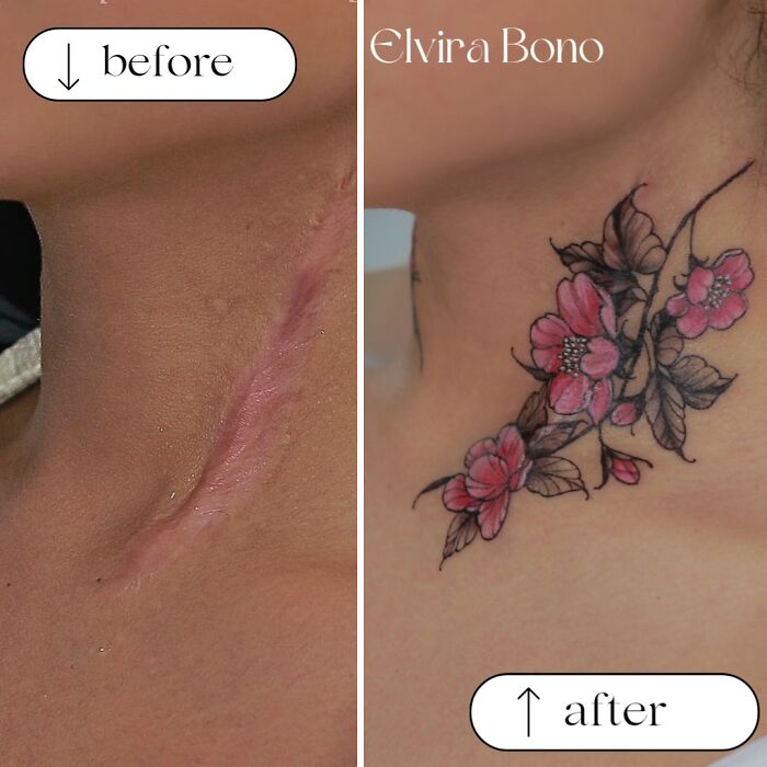 Surgical Scar? Let's Make It A Tattoo Masterpiece