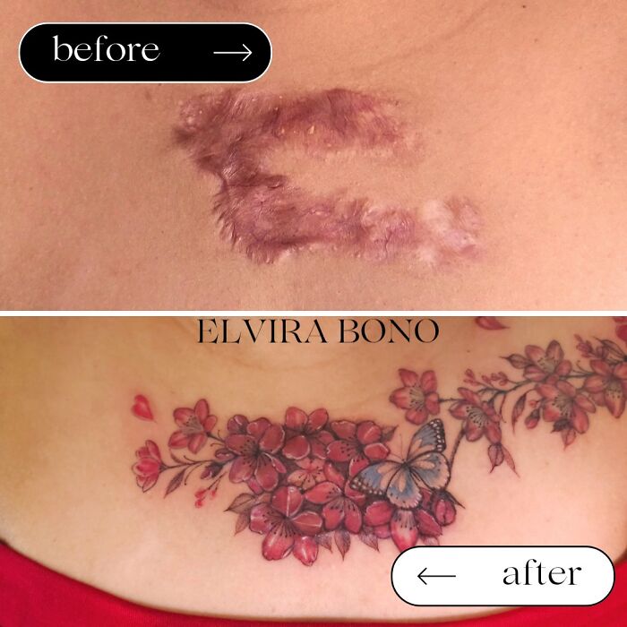 Acne Keloid Scar? Watch This Tattoo Transformation