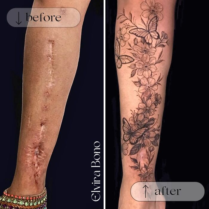 Traffic Accident Surgical Scar Gets Some Tattoo Love