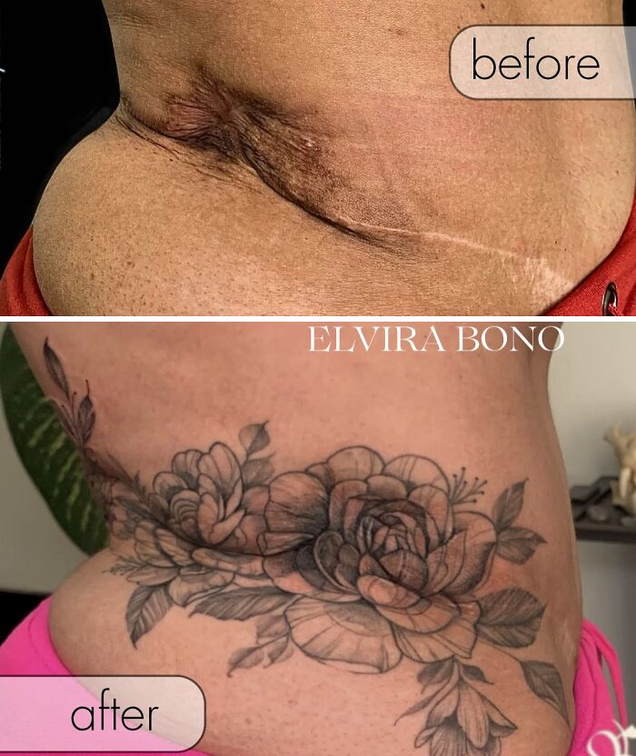 Deep Surgical Scar? Tattoo Artist To The Rescue!