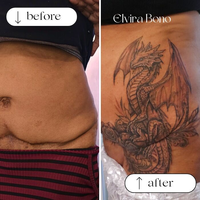 Abdominoplasty Scar? Let's Ink It Up!