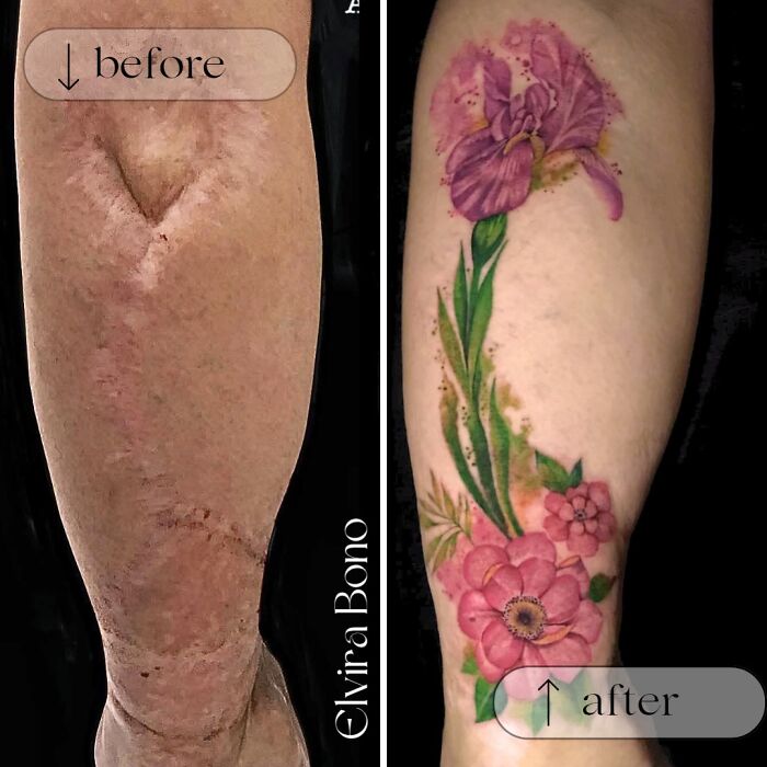 Traffic Accident Surgical Scar? Tattoo's Got It Covered