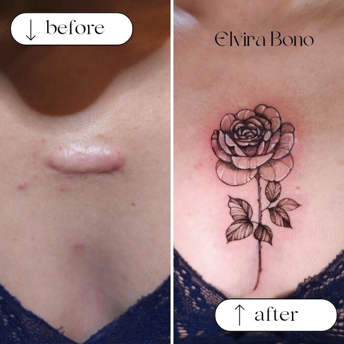 Keloid Scar Gets Some Tattoo Flair