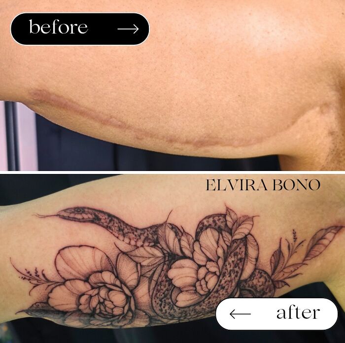 Tattoo On Arm Lift Scar After Weight Loss - Big Win!