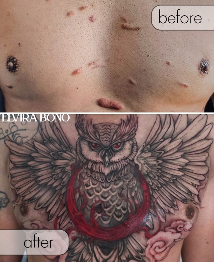Acne Scars With Keloids? There's A Tattoo For That