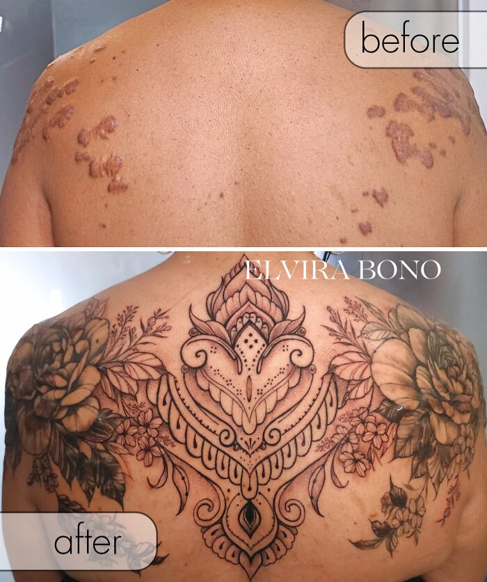 Tattoo Turnaround For Acne Scar With Keloid
