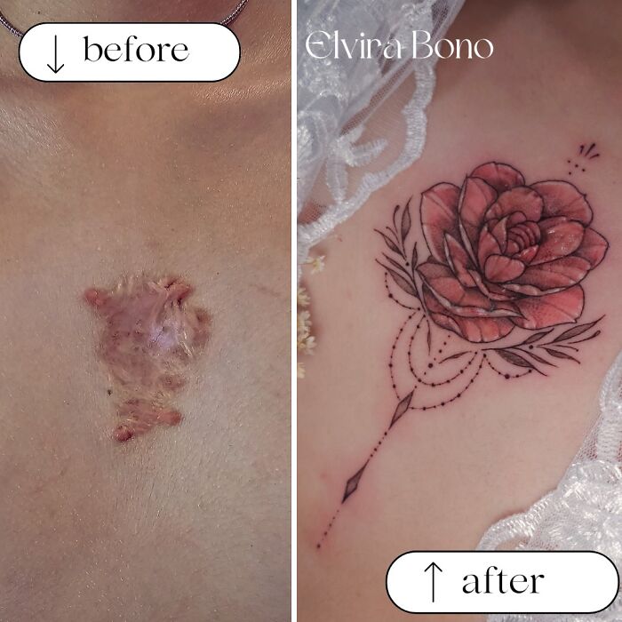Keloid Scar Gets Some Tattoo Swag