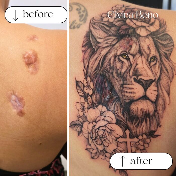 Keloid Scars For Acne Get Tattooed Up