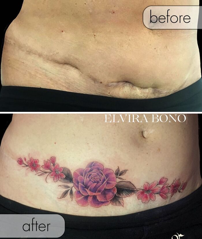 Complicated Abdominoplasty Scar? Hello Tattoo Style!