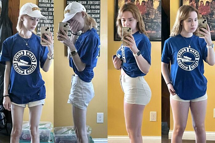 F/19/5'4" [Lost 53lbs in 5 Months] A Comeback Story from Eating Disorder Recovery