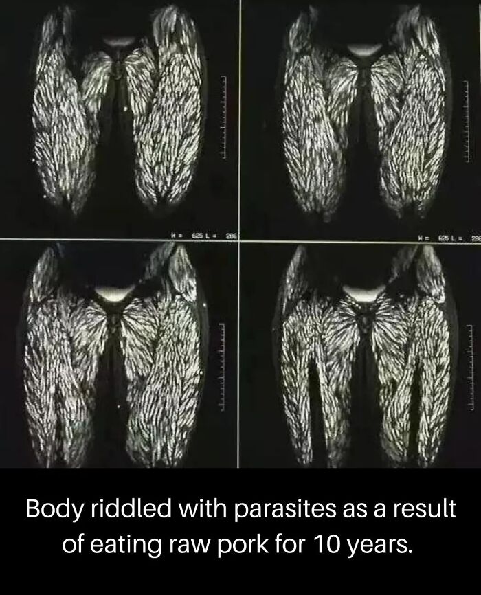 Body Riddled With Parasites Because Of Raw Pork Experiment Gone Wrong