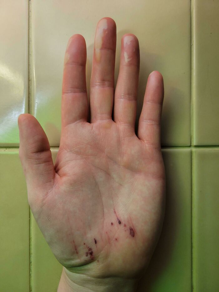 Burned Fingers Plus Ice Slip Equals Ouch Times Two