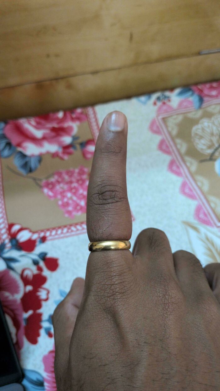 Ring Stuck On Finger, Soap Isn’t Helping! Help!