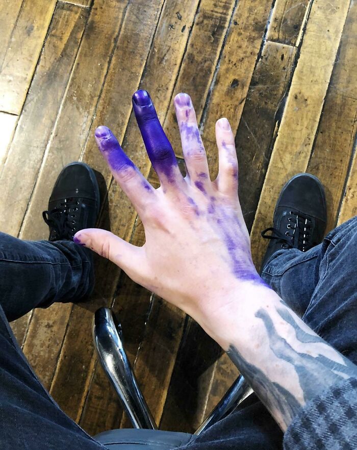 Coworker Put Printer Ink Straight on My Glove. Goodbye Skin for 2 Weeks