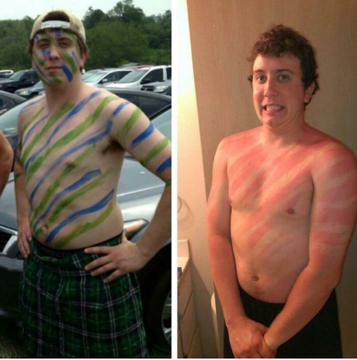 Someone Forgot Sunscreen And Got The Lobster Look