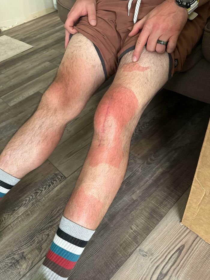 Went To Son’s Soccer Game With A Knee Brace... And Forgot Sunscreen Too