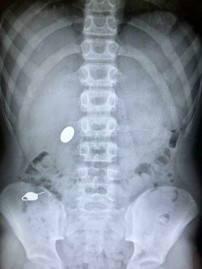 Kid Swallows Penny While Teaching Bro How NOT to Swallow SIM Keys