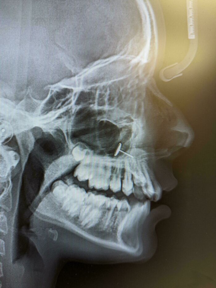 Kid Tries DIY Nose Piercing... Accidentally Inhales Earring