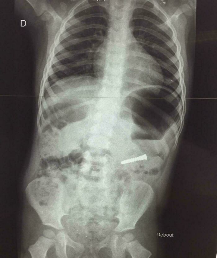 Son Eats Random Screw Found On Street. No Injuries!