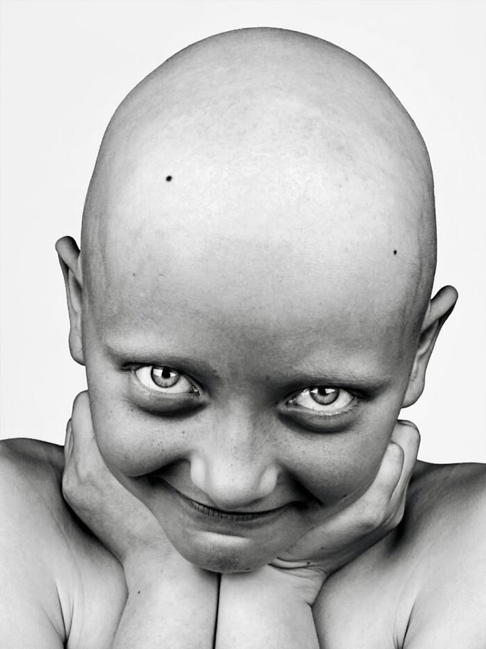 Teresa: Alopecia Ace