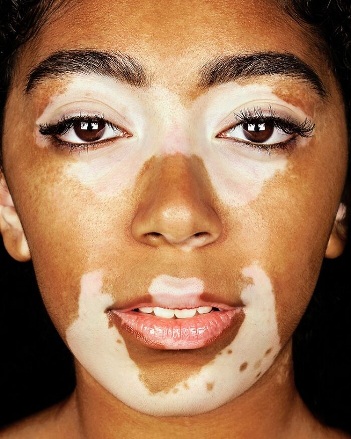 Leonie Timothy: Vitiligo Vogue
