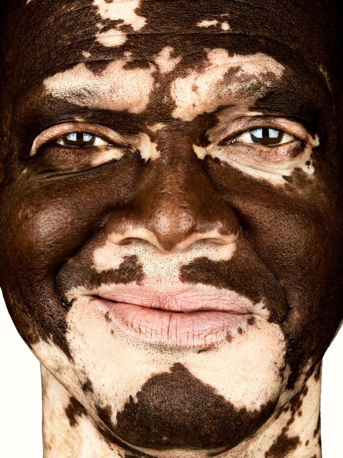 Lle Thomas: Vitiligo Visionary