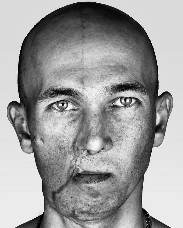 Oleksandr: The Facelift Fighter