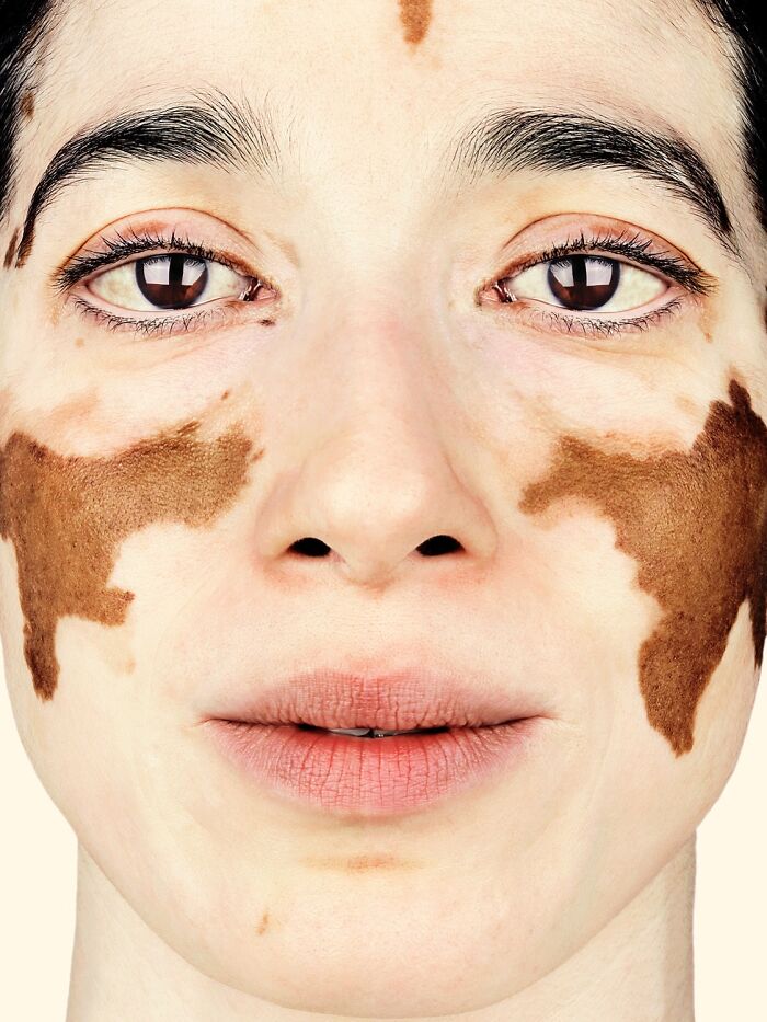 Padmine Gajadhar: Vitiligo Star