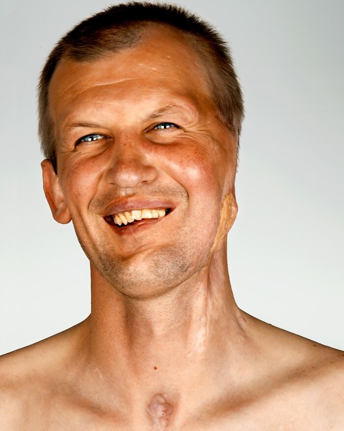 Yuriy: The Brave Face of Recovery
