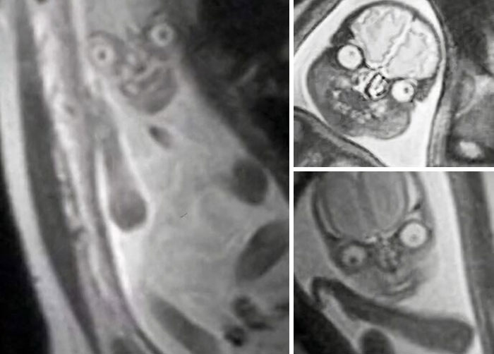 What A Fetus Looks Like In An MRI (Hint: Not Cute)