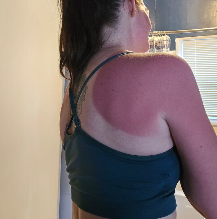 Sunscreen? Nah, Sunburn It Is!