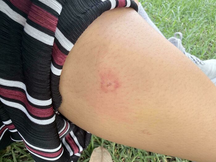 What Bit Me? The Itch is Real!
