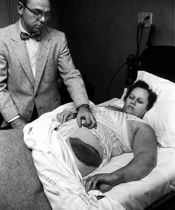 Ann Hodges: Only Human Hit By A Meteorite, 1954