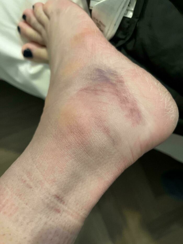First Day in Italy and I Fell on the Sidewalk—Ankle Sprained!