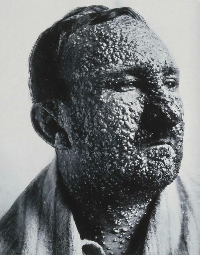 Man With Smallpox, Circa 1900 — Not Your Average Selfie