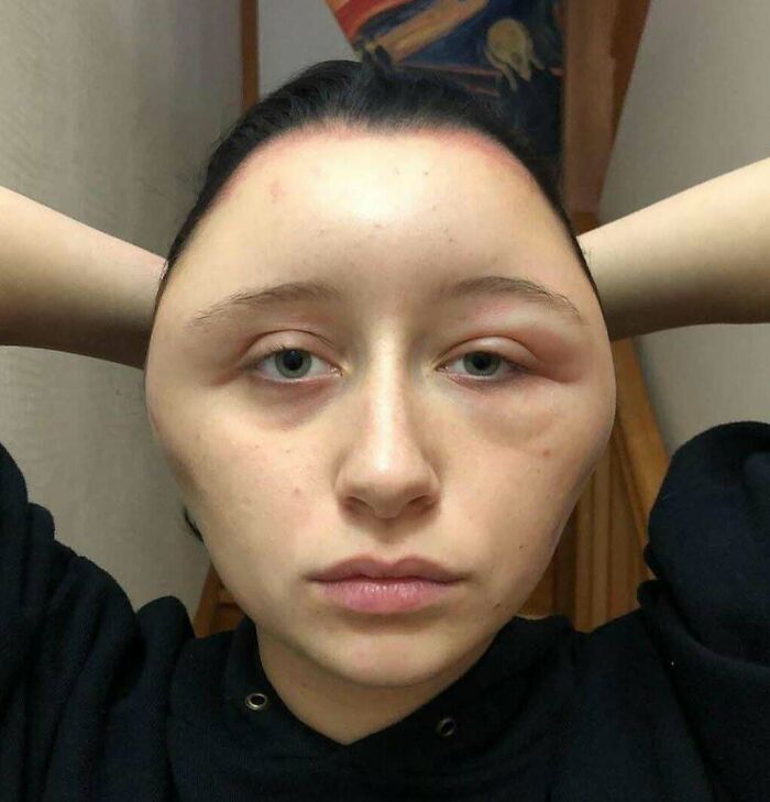 Girl’s Head After Allergic Reaction to Home Hair Dye Kit – Ouch!