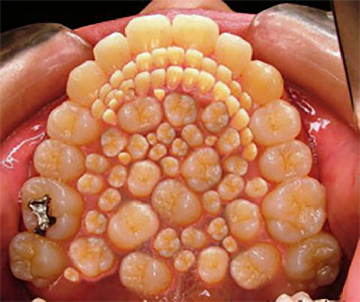 Hyperdontia – Teeth on Teeth on Teeth!