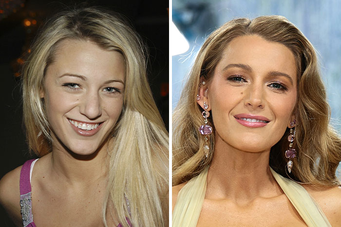 Blake Lively: Teens with Braces to Red Carpet Queen
